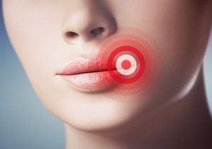 lippen herpes infektion