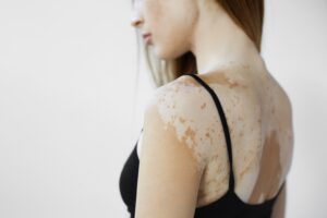 pigmentstoerung ursachen frau mit vitiligo