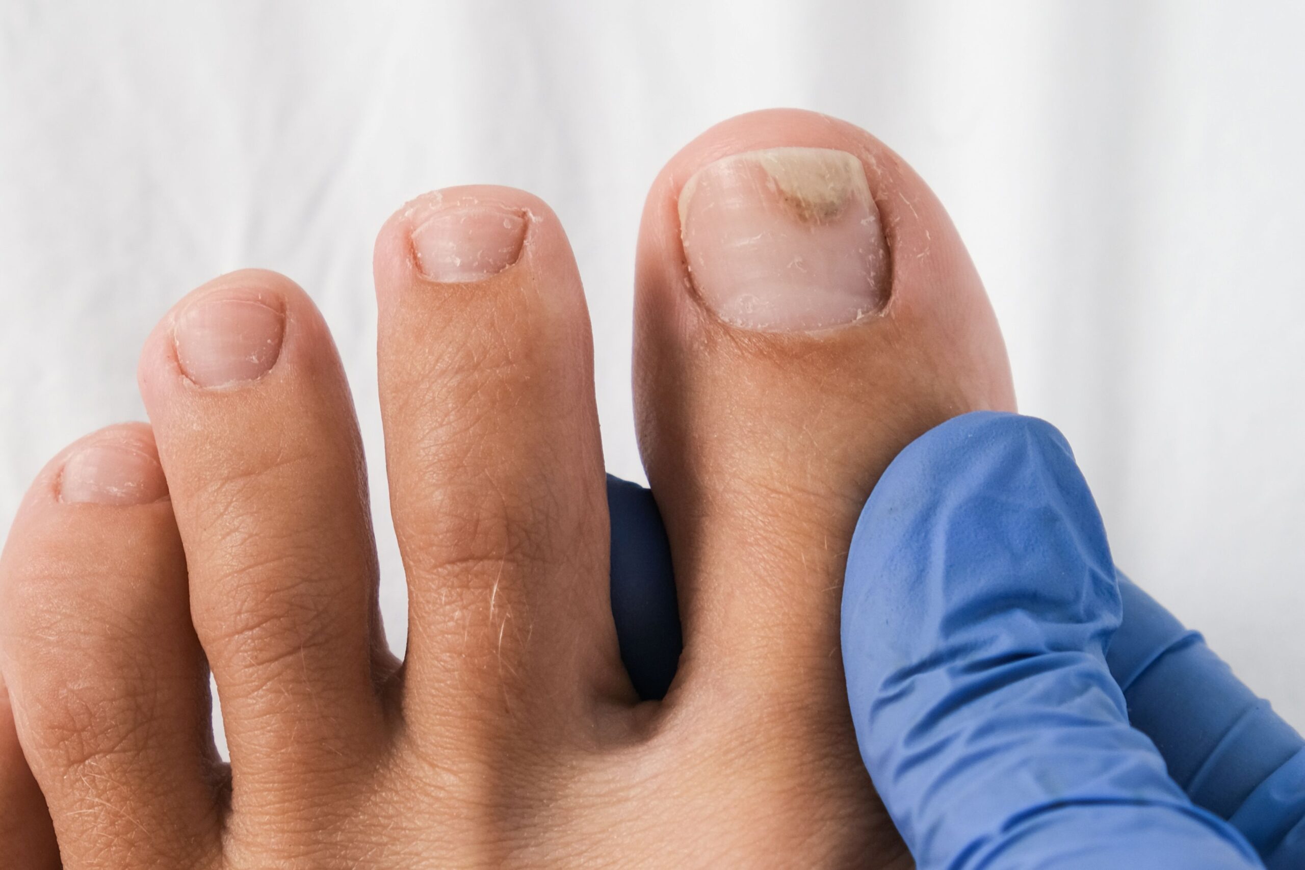 Eine Hand in einem blauen Latexhandschuh hält einen großen Zeh fest, an dessen Nagel leichte Verfärbungen zu erkennen sind.