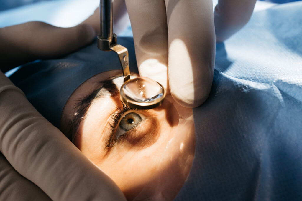 Augenlaserbehandlung am geöffneten Auge mit medizinischen Instrumenten unter Operationsbeleuchtung